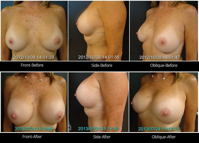 Breast Implant Revision Before & After 7 Full