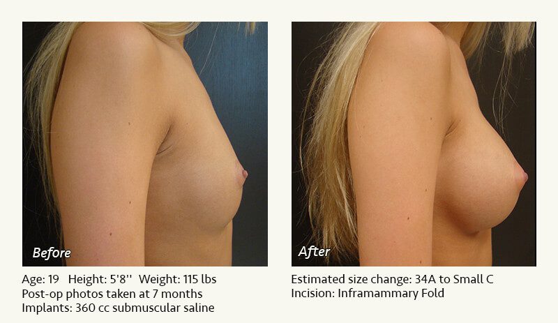Breast Augmentation in Plano, TX - Patient 78