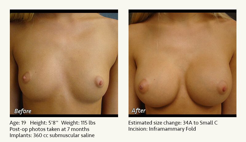 Breast Augmentation in Plano, TX - Patient 77