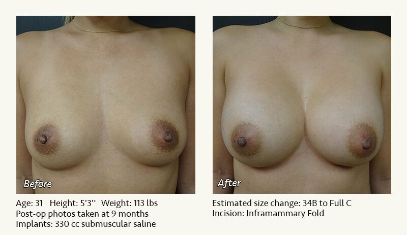 Breast Augmentation in Plano, TX - Patient 75