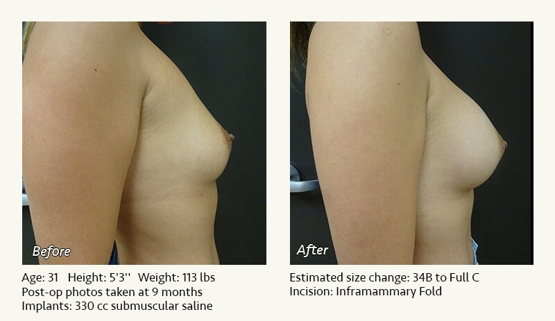 Breast Augmentation in Plano, TX - Patient 76