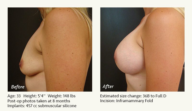 Breast Augmentation in Plano, TX - Patient 80