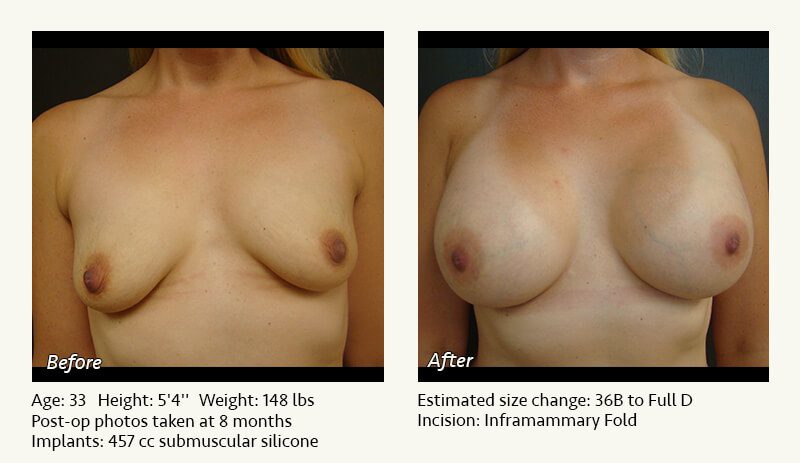 Breast Augmentation in Plano, TX - Patient 79