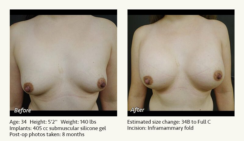 Breast Augmentation in Plano, TX - Patient 73