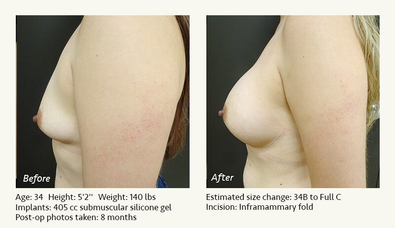 Breast Augmentation in Plano, TX - Patient 74