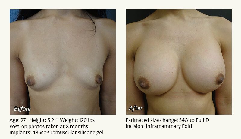 Breast Augmentation in Plano, TX - Patient 71