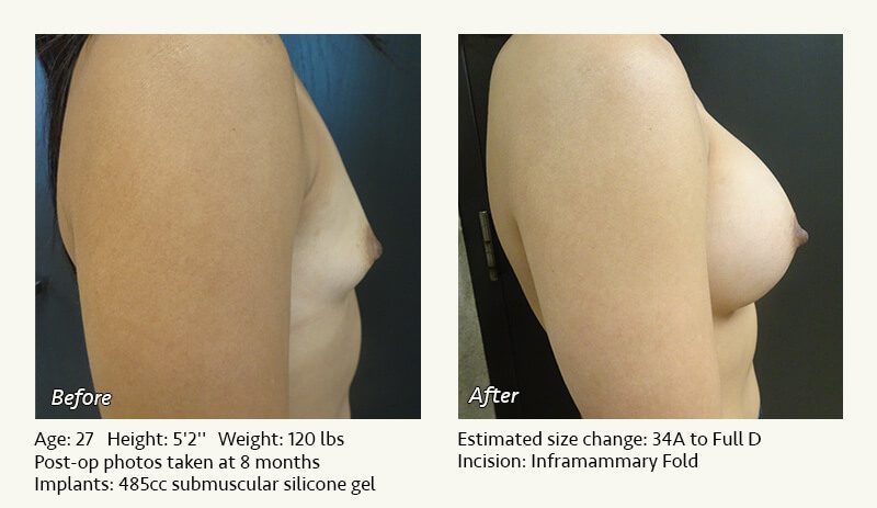 Breast Augmentation in Plano, TX - Patient 72