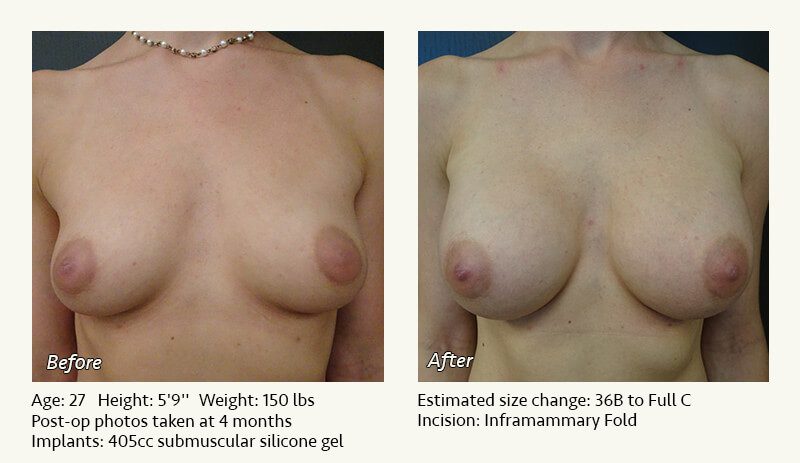 Breast Augmentation in Plano, TX - Patient 69