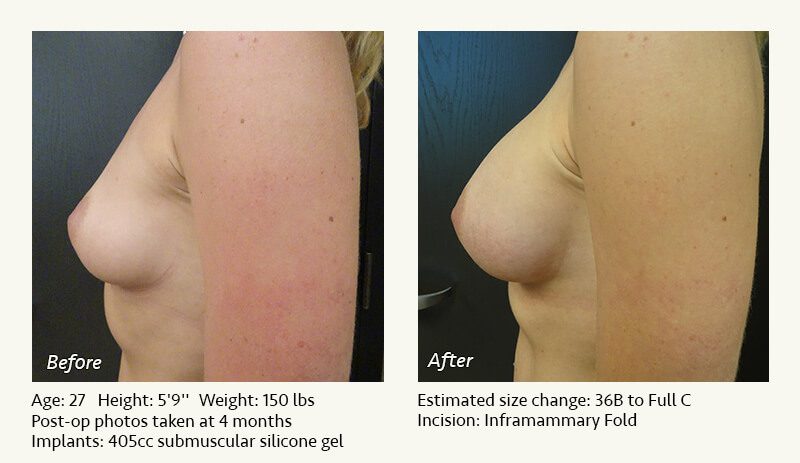 Breast Augmentation in Plano, TX - Patient 70