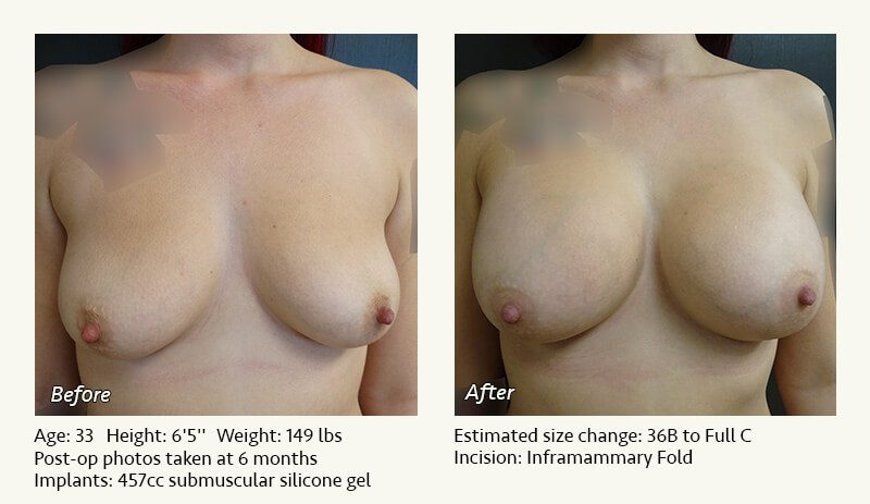 Breast Augmentation in Plano, TX - Patient 67