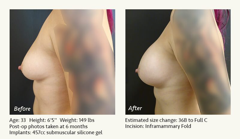Breast Augmentation in Plano, TX - Patient 68