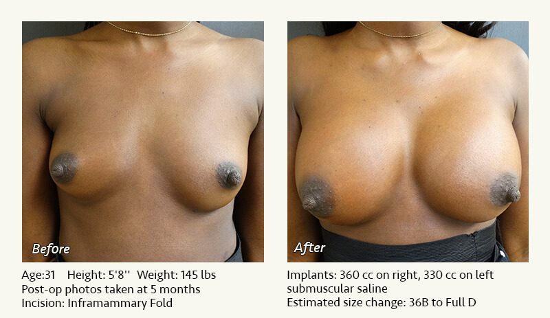 Breast Augmentation in Plano, TX - Patient 65