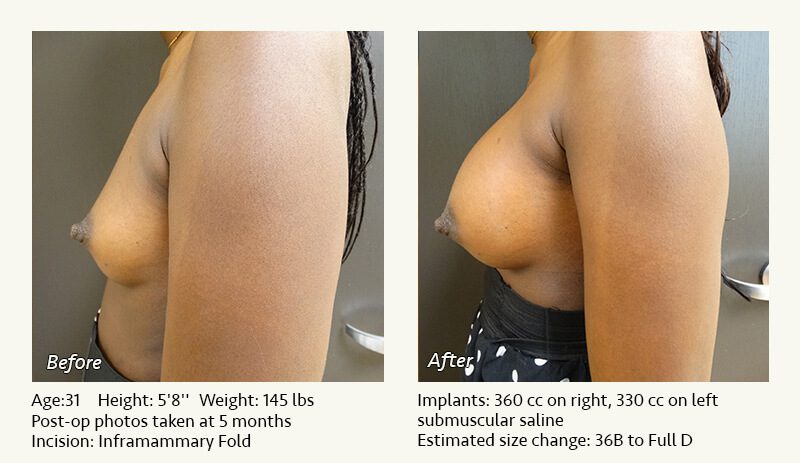 Breast Augmentation in Plano, TX - Patient 66