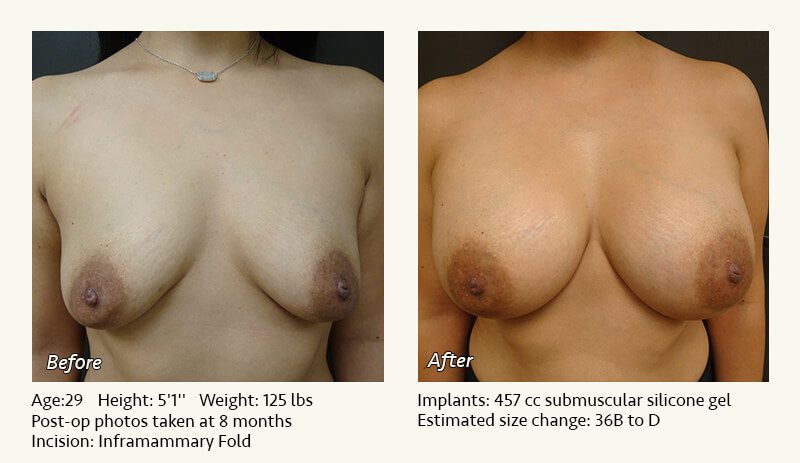 Breast Augmentation in Plano, TX - Patient 63