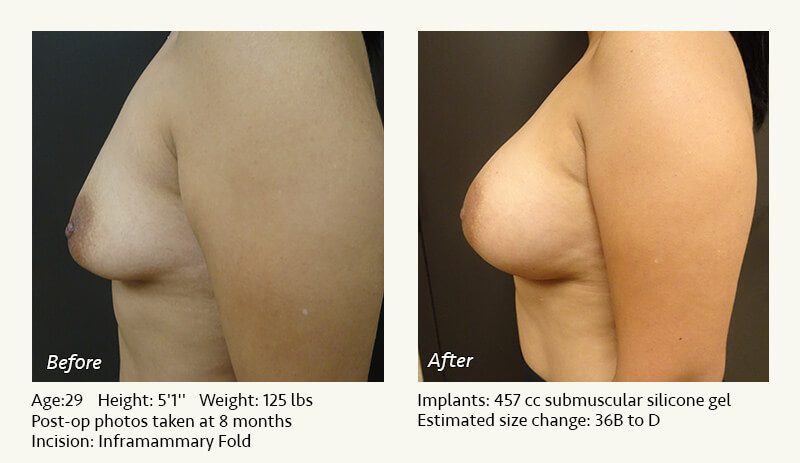 Breast Augmentation in Plano, TX - Patient 64