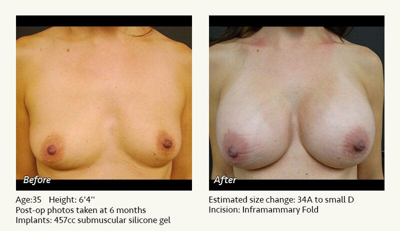 Breast Augmentation in Plano, TX - Patient 61