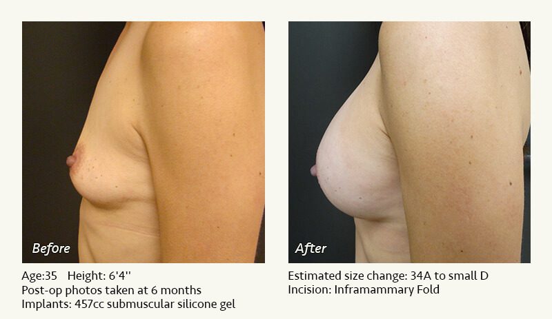 Breast Augmentation in Plano, TX - Patient 62