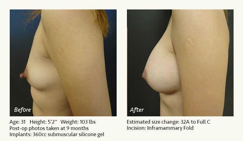 Breast Augmentation in Plano, TX - Patient 60