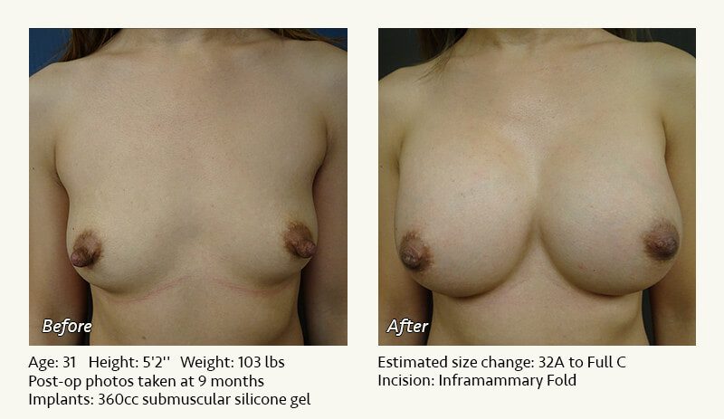 Breast Augmentation in Plano, TX - Patient 59