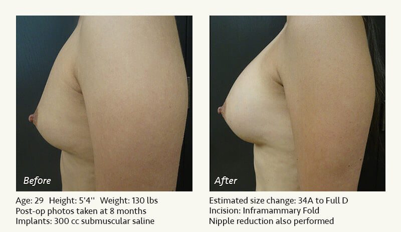 Breast Augmentation in Plano, TX - Patient 58