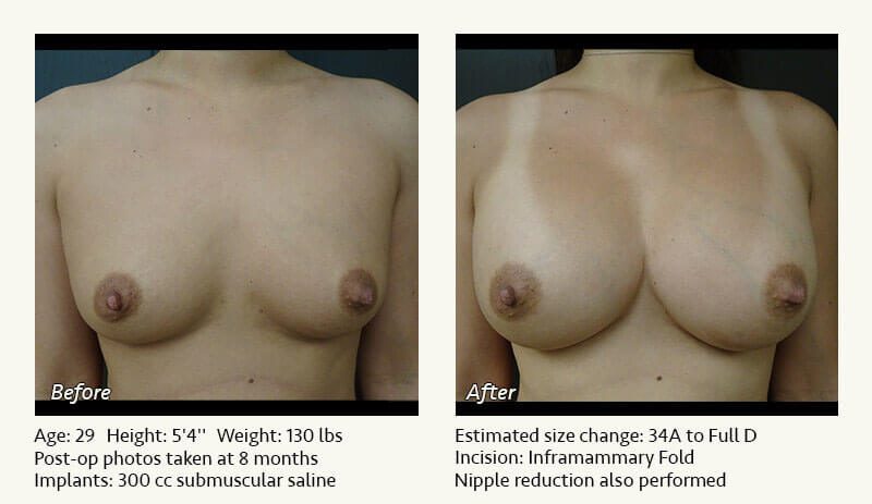 Breast Augmentation in Plano, TX - Patient 57