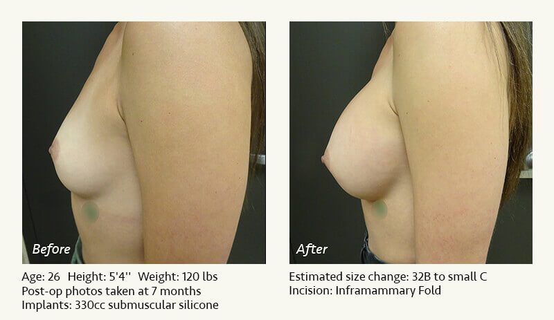 Breast Augmentation in Plano, TX - Patient 56