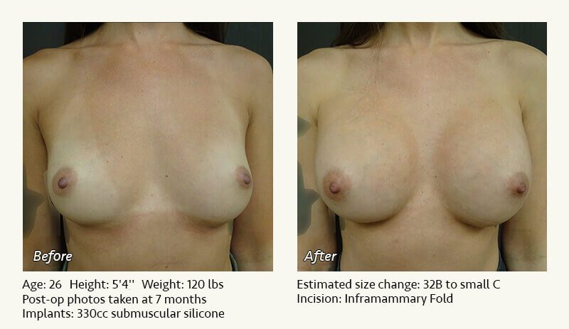 Breast Augmentation in Plano, TX - Patient 55