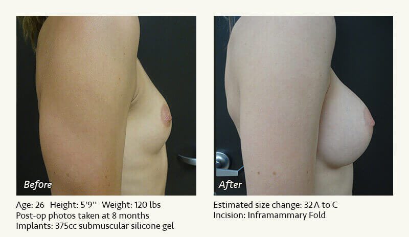 Breast Augmentation in Plano, TX - Patient 54