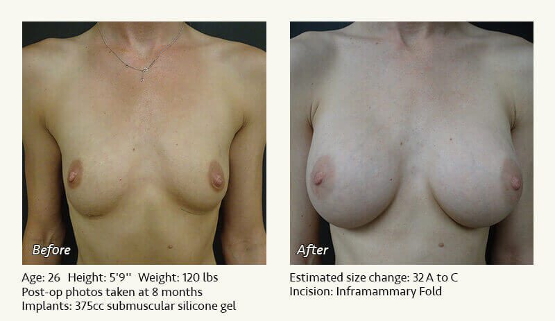 Breast Augmentation in Plano, TX - Patient 53