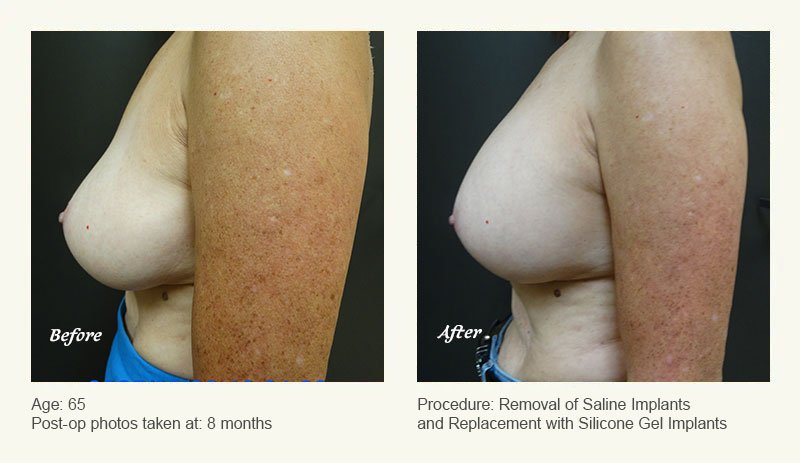 Breast Implant Revision in Plano, TX - Patient 2
