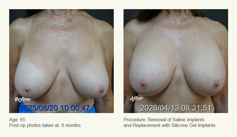 Breast Implant Revision in Plano, TX - Patient 1