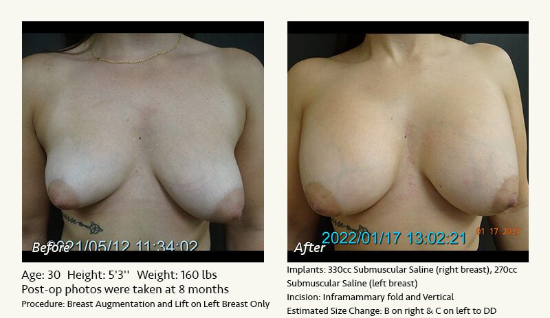 Breast Lift in Plano & Dallas, TX - Patient 17