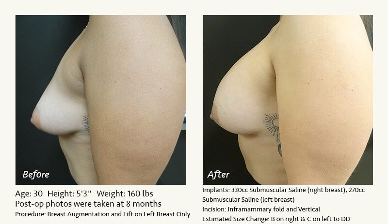 Breast Lift in Plano & Dallas, TX - Patient 18