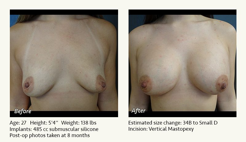 Breast Lift in Plano & Dallas, TX - Patient 44