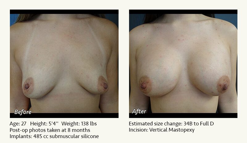 Breast Lift in Plano & Dallas, TX - Patient 34