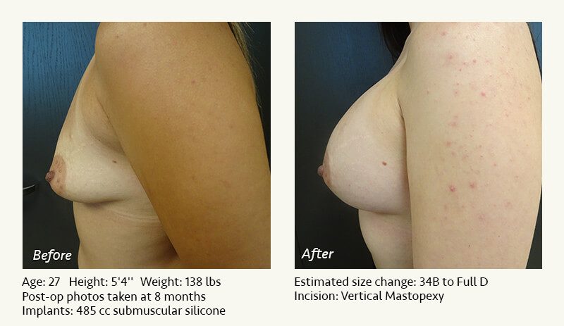 Breast Lift in Plano & Dallas, TX - Patient 35
