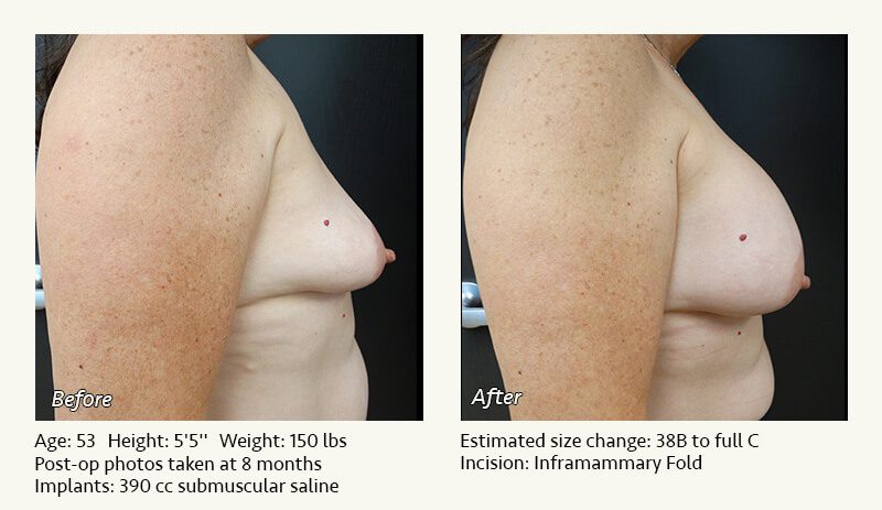 Breast Lift in Plano & Dallas, TX - Patient 16
