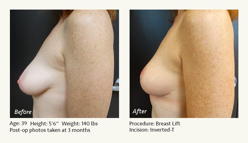 Breast Lift in Plano & Dallas, TX - Patient 33
