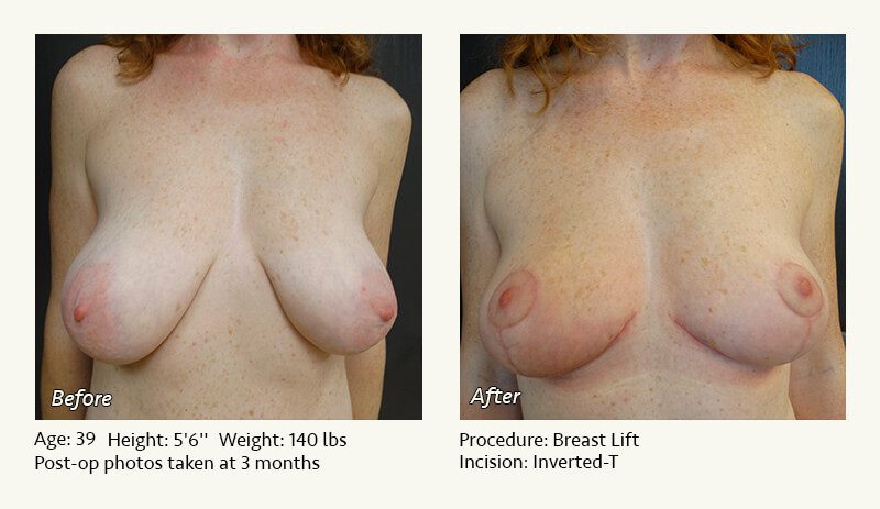Breast Lift in Plano & Dallas, TX - Patient 32