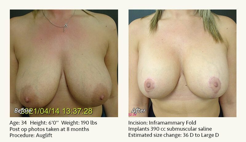 Breast Lift in Plano & Dallas, TX - Patient 24