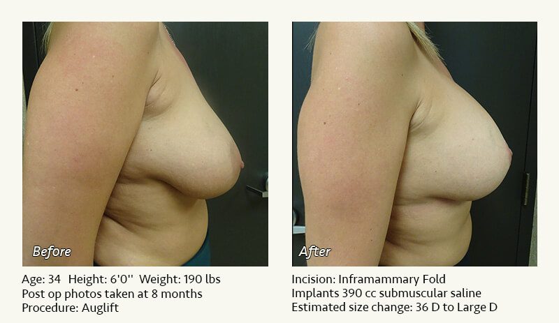 Breast Lift in Plano & Dallas, TX - Patient 25
