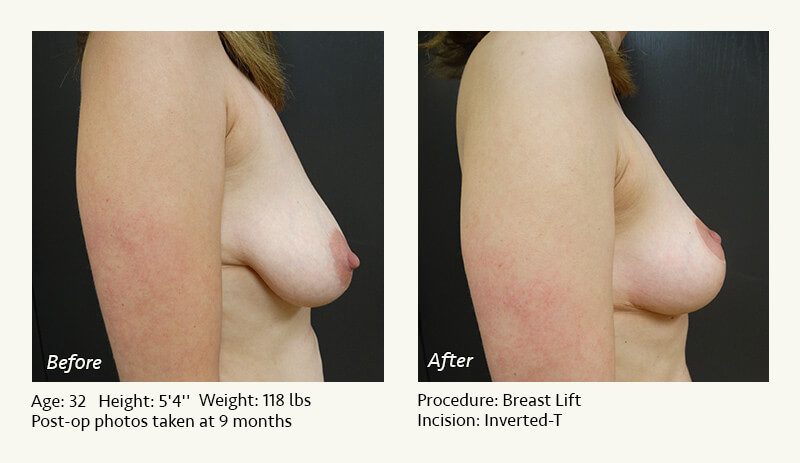 Breast Lift in Plano & Dallas, TX - Patient 31