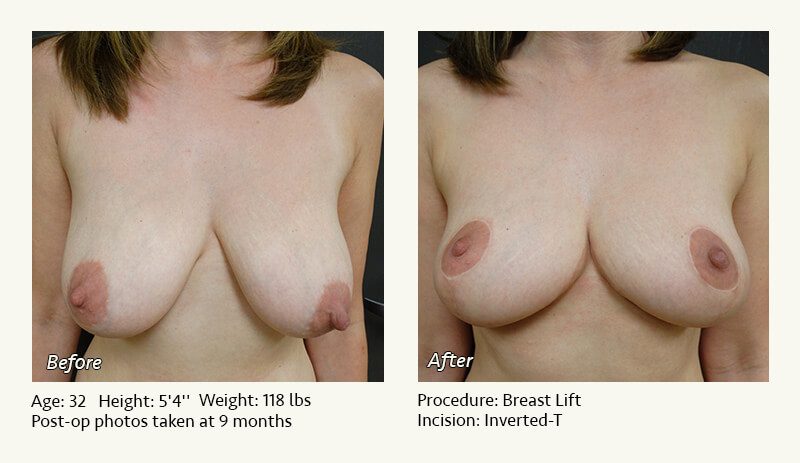 Breast Lift in Plano & Dallas, TX - Patient 30