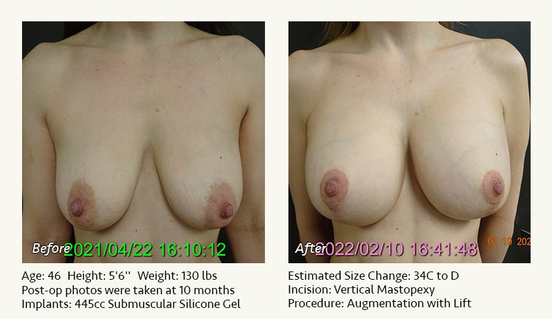 Breast Lift in Plano & Dallas, TX - Patient 22