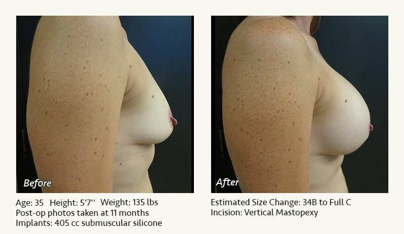 Breast Lift in Plano & Dallas, TX - Patient 29