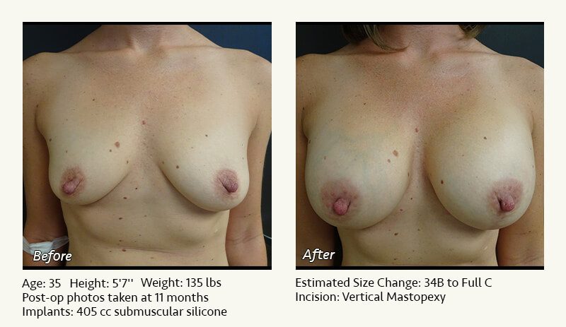 Breast Lift in Plano & Dallas, TX - Patient 28