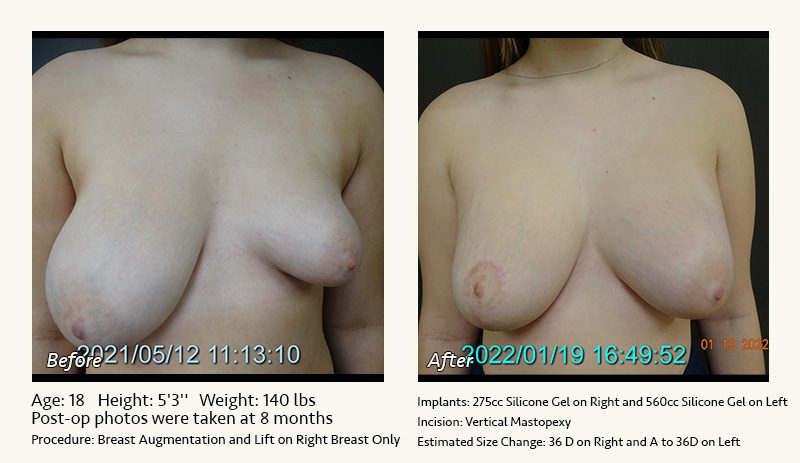 Breast Lift in Plano & Dallas, TX - Patient 19