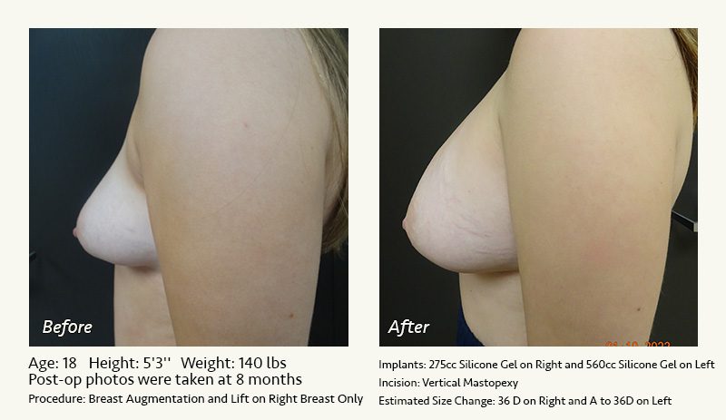 Breast Lift in Plano & Dallas, TX - Patient 21