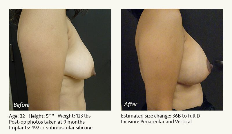 Breast Lift in Plano & Dallas, TX - Patient 27