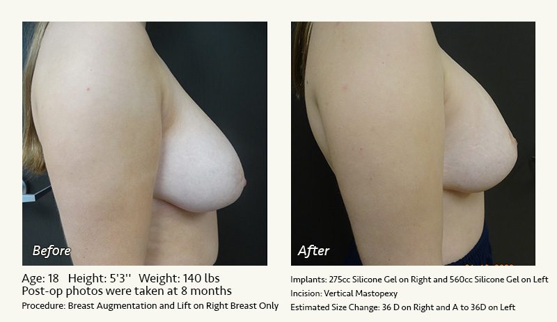 Breast Lift in Plano & Dallas, TX - Patient 20